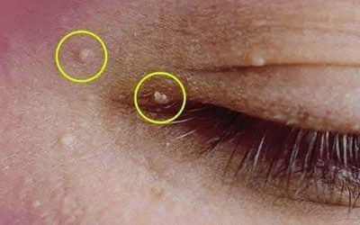 Éliminez les microkystes disgracieux : nos astuces pour une peau parfaitement lisse