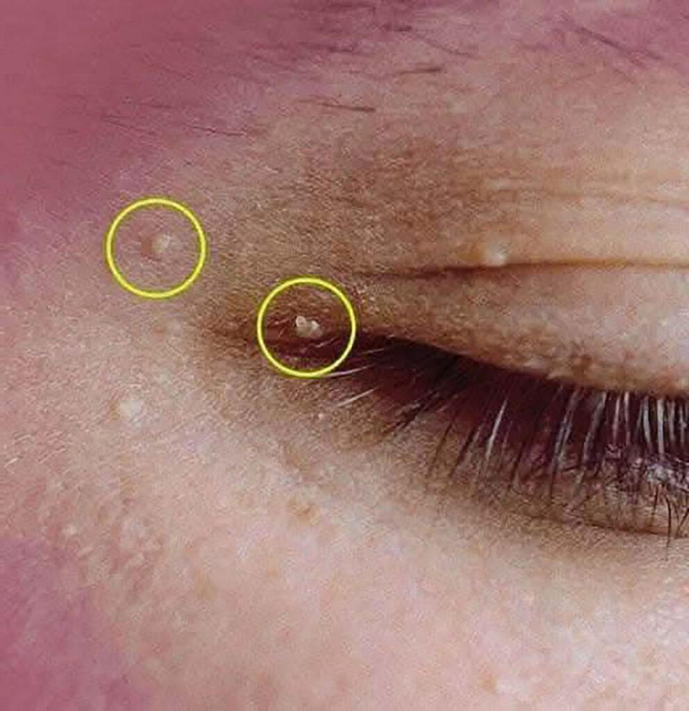 Éliminez les microkystes disgracieux : nos astuces pour une peau parfaitement lisse