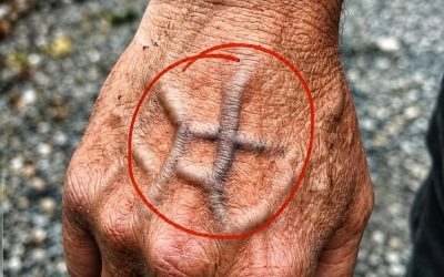 Milloin sinun pitäisi olla huolissasi äkillisesti ilmaantuneista suonista?