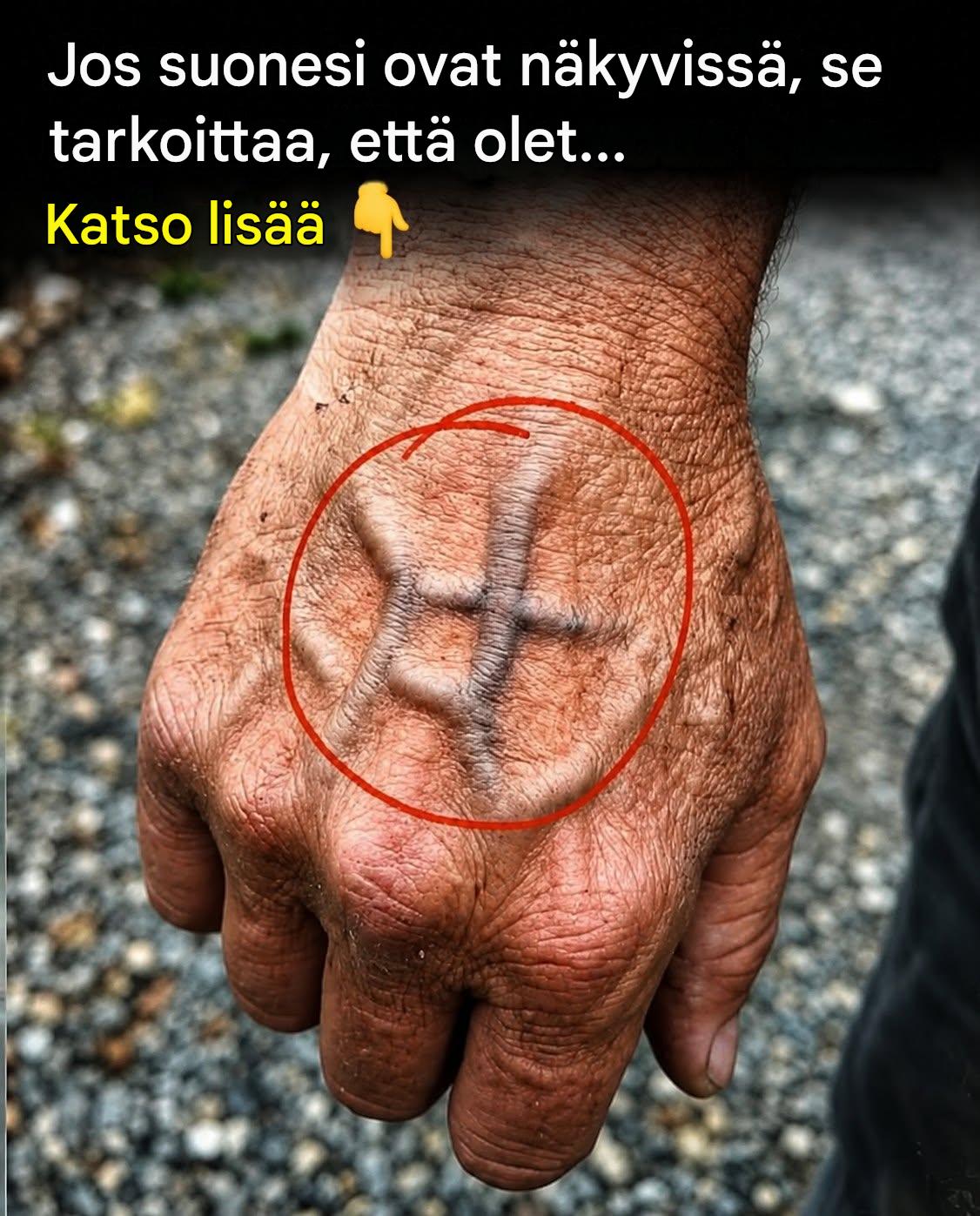Milloin sinun pitäisi olla huolissasi äkillisesti ilmaantuneista suonista?